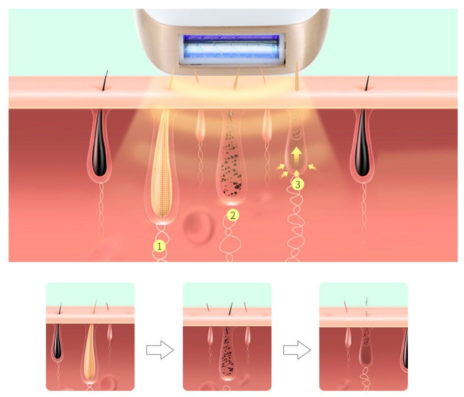 IPL Laser Hair Removal Device – Safe, Painless & Long-Lasting Results