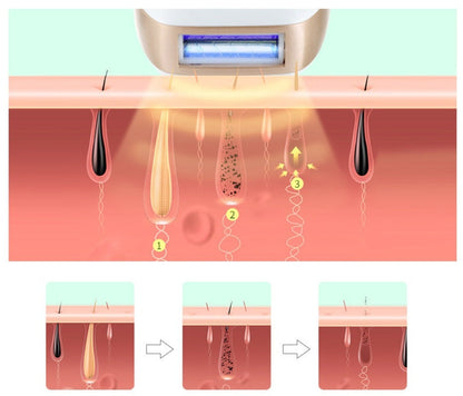 IPL Laser Hair Removal Device – Safe, Painless & Long-Lasting Results
